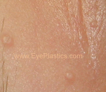 Molluscum Contagiosum